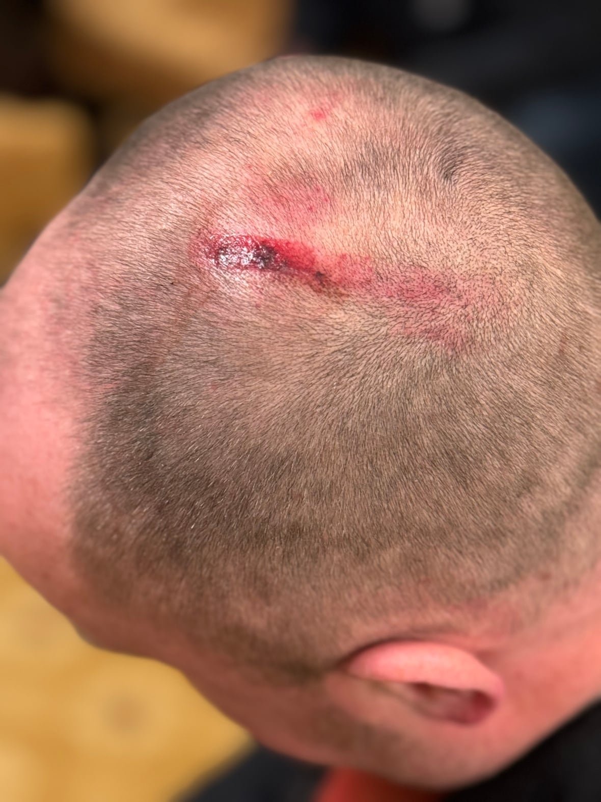 A cut is seen on top of a person's head.