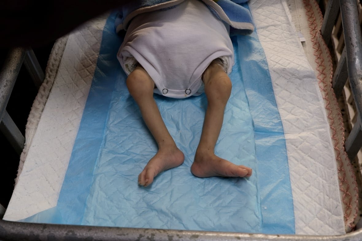israel-palestinians-gaza-health The gaunt legs of a Palestinian girl lying on a hospital bed.